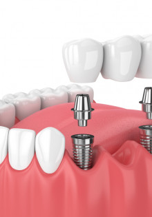 Импланты зубов: инновационное решение проблем с зубами
