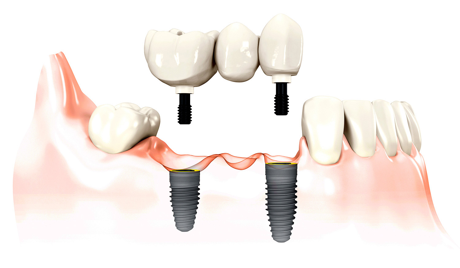 Виды имплантаций зубов