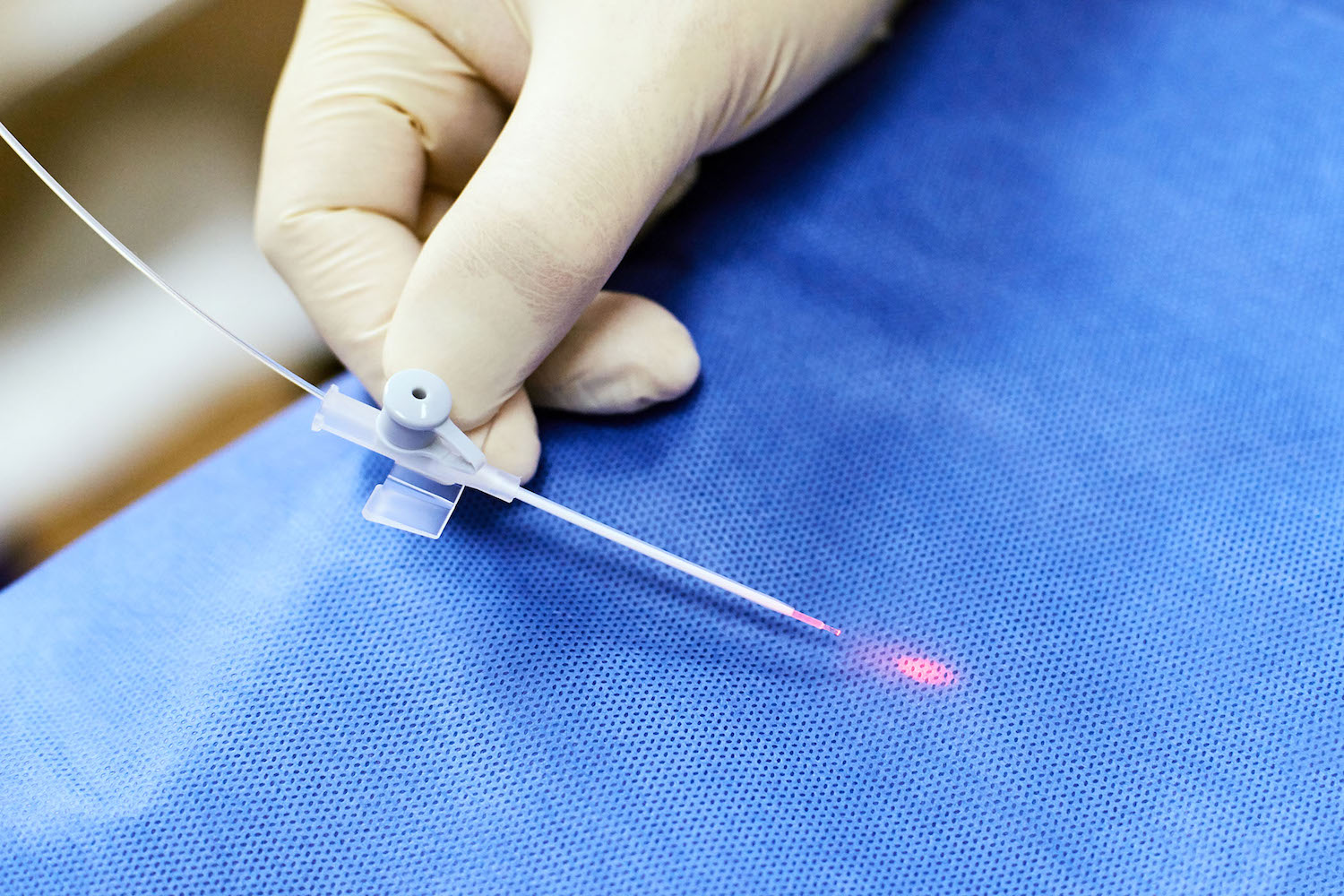 Как проводится эндовенозная лазерная коагуляция (ЭВЛК)?