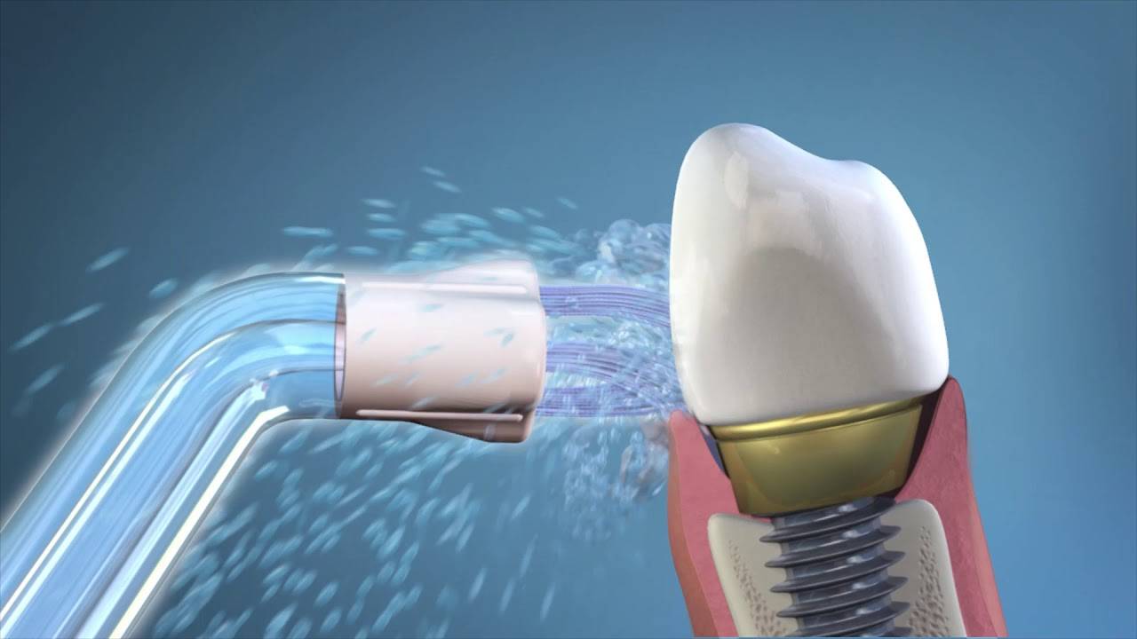Как ухаживать за имплантами зубов