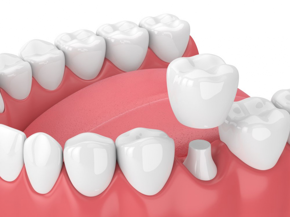 Какие коронки устанавливают в стоматологиях?