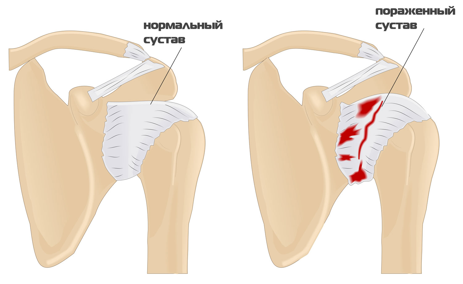 Особенности лечения коленных и плечевых суставов