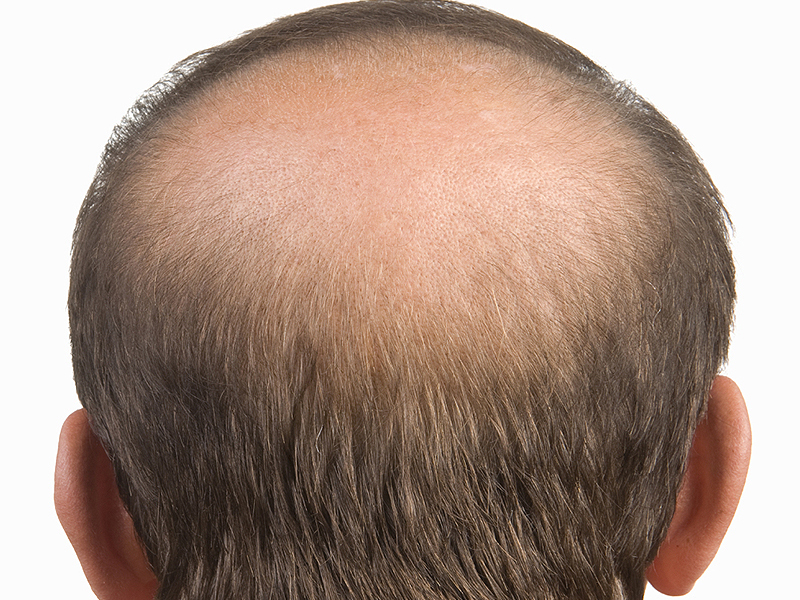 Почему выпадают волосы на голове у мужчин причины в большом количестве