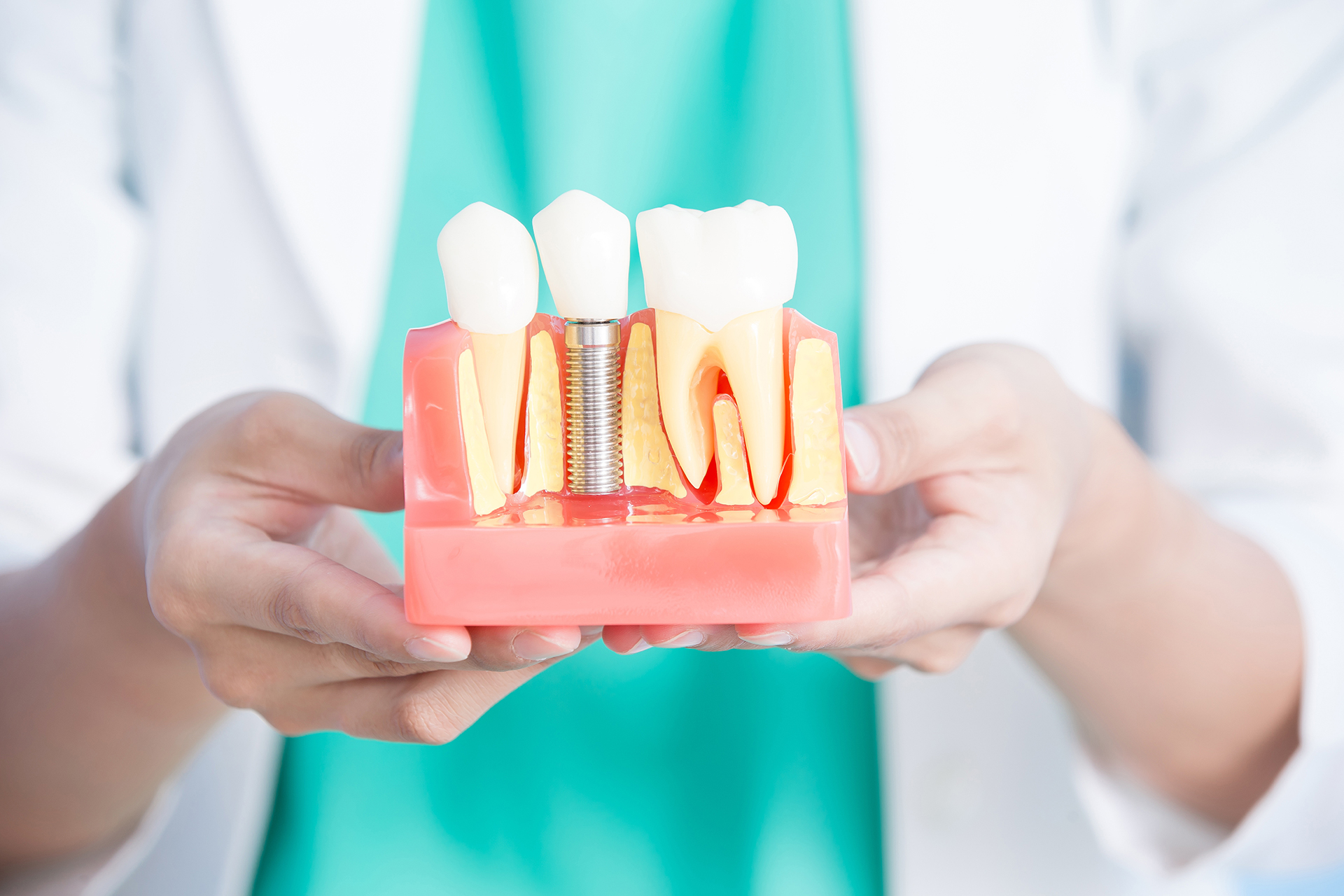 Имплантация зубов: виды и этапы