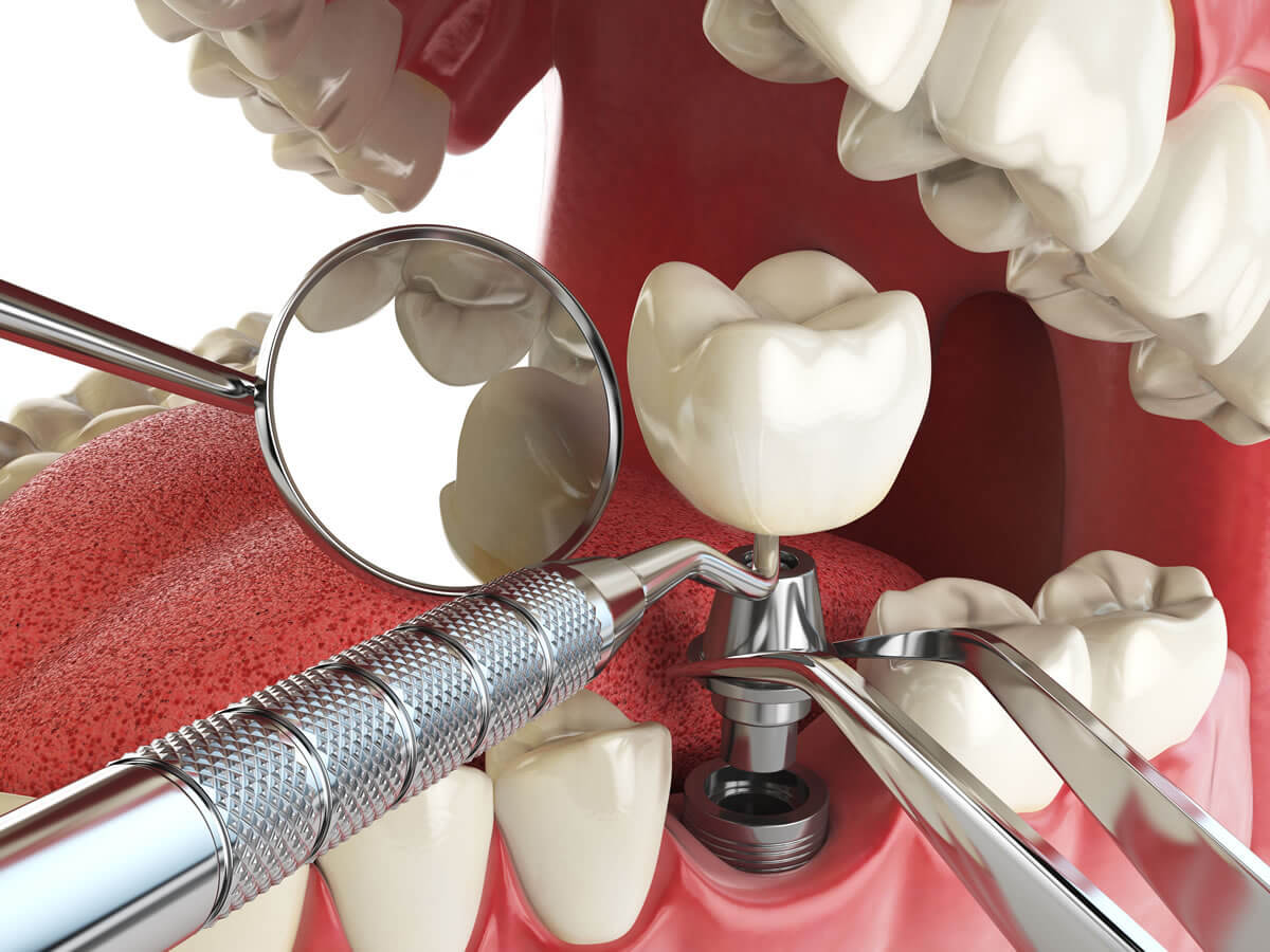 Кому необходимо сделать имплант зуба?