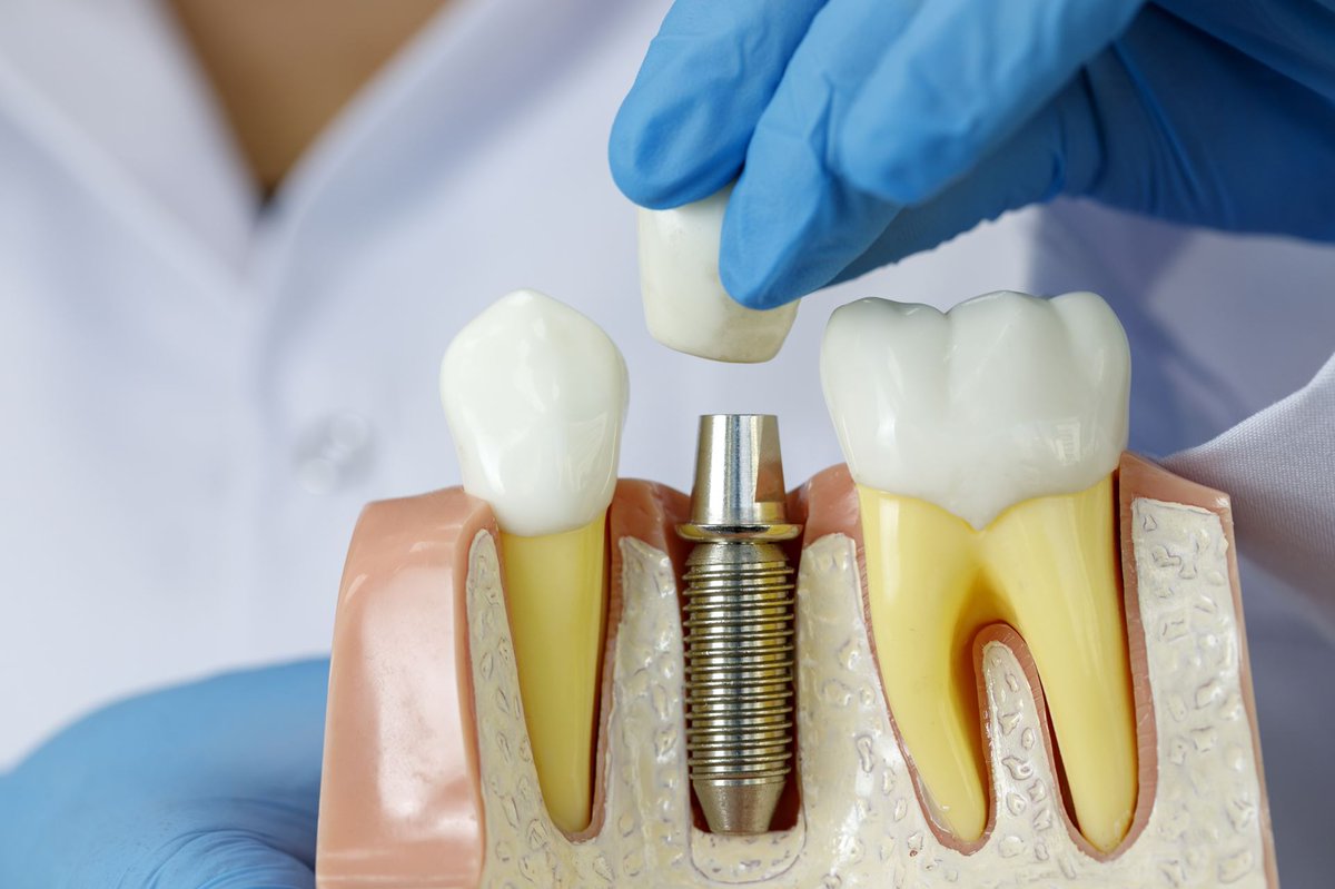 Имплантация зубов: виды и этапы