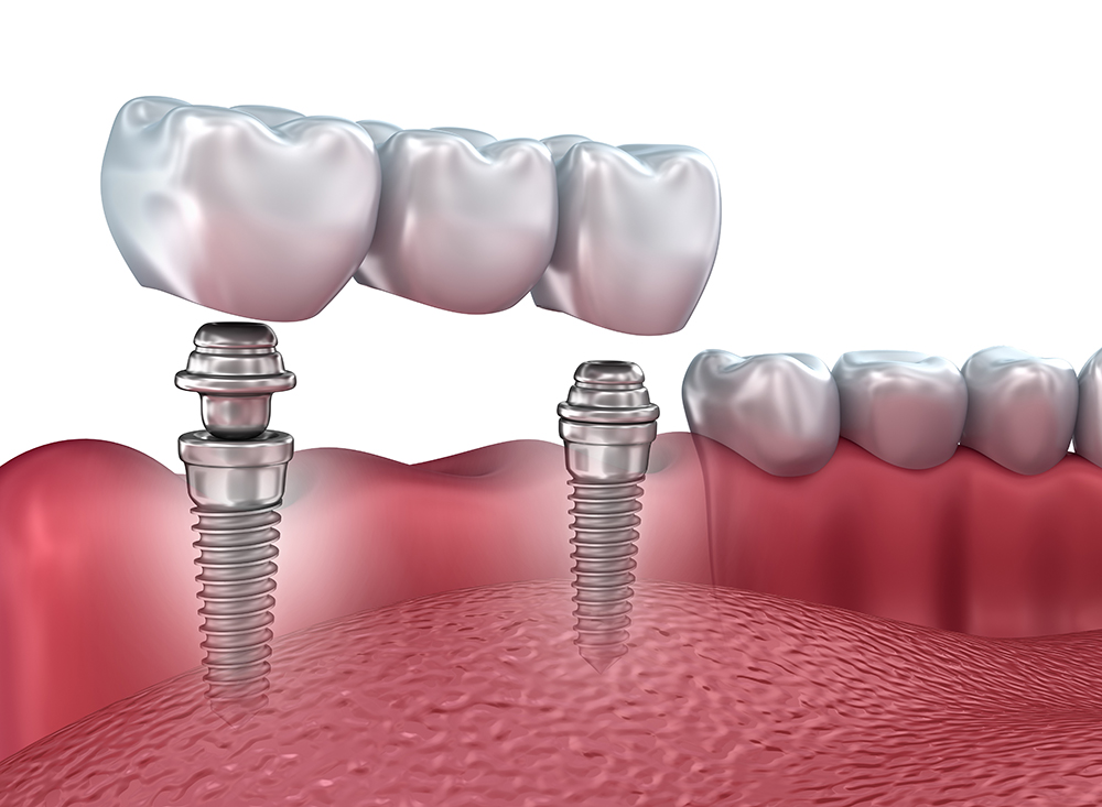 Протезирование зубов на имплантах: описание процедуры