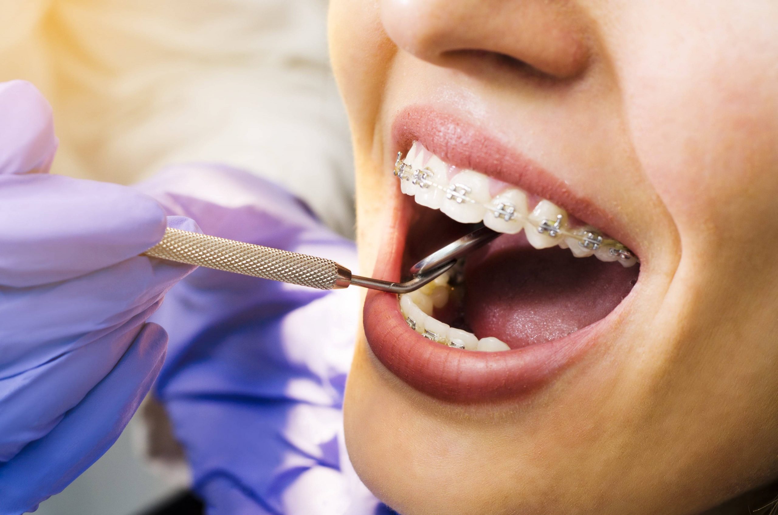 Особенности ортодонтии в стоматологиях