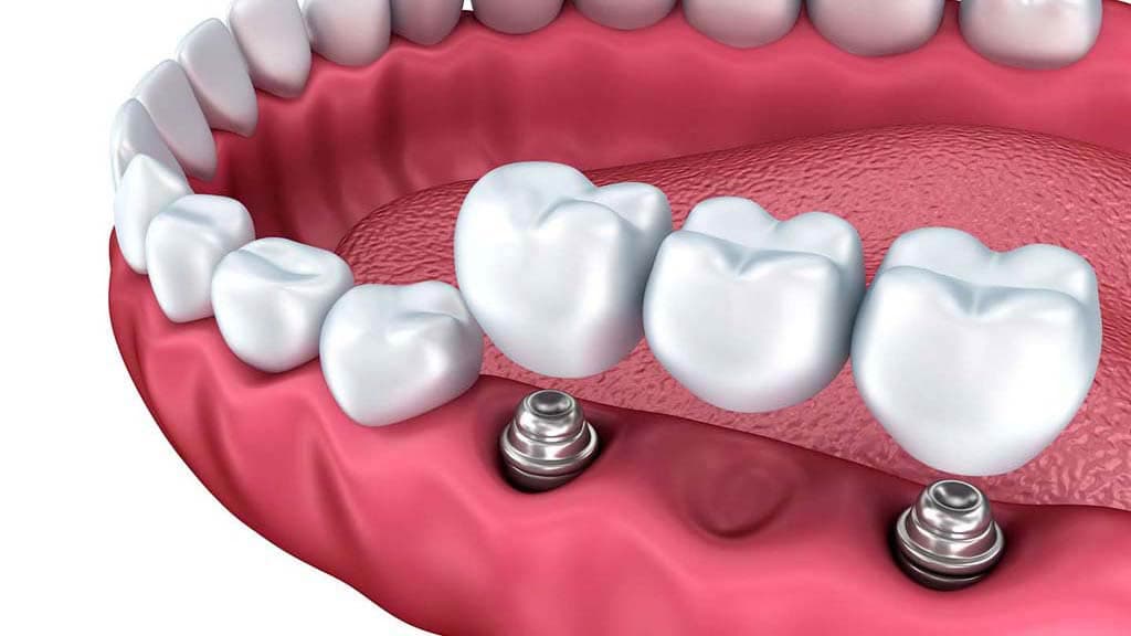 Протезирование зубов на имплантах: описание процедуры