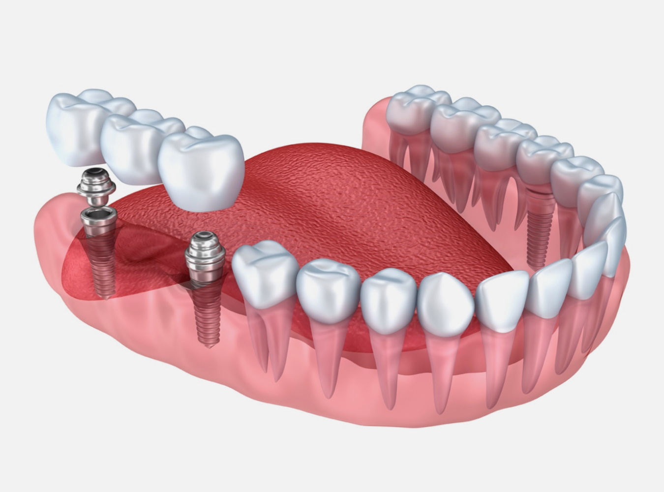 Разновидности имплантов для зубов