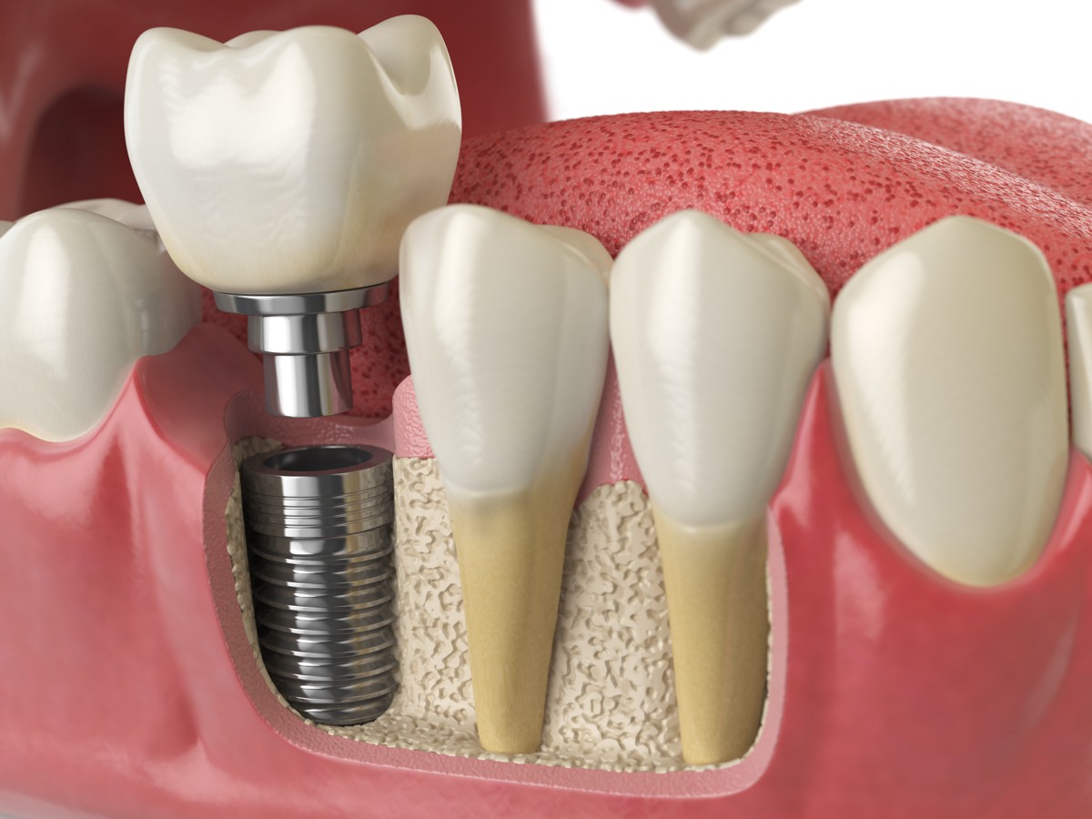 Разновидности имплантов для зубов