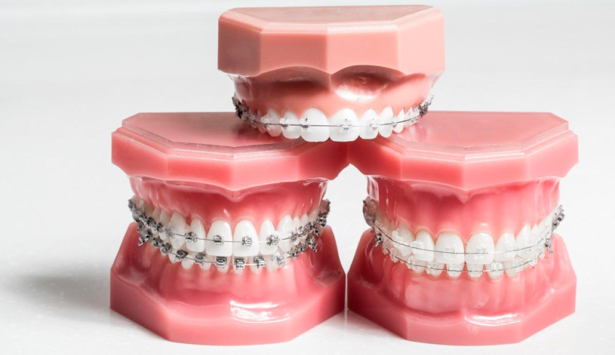 Разновидности брекетов для зубов