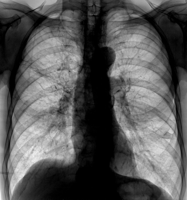 КТ или рентген лёгких: что лучше?