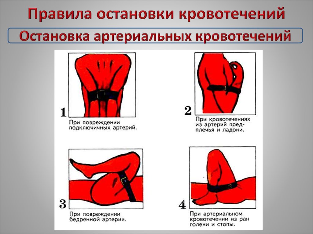 Правила остановки кровотечения - восемь способов