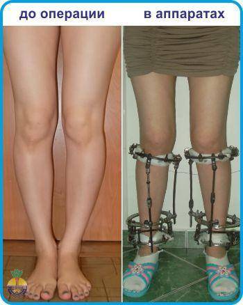 Операции по исправлению кривизны ног: как проводится?