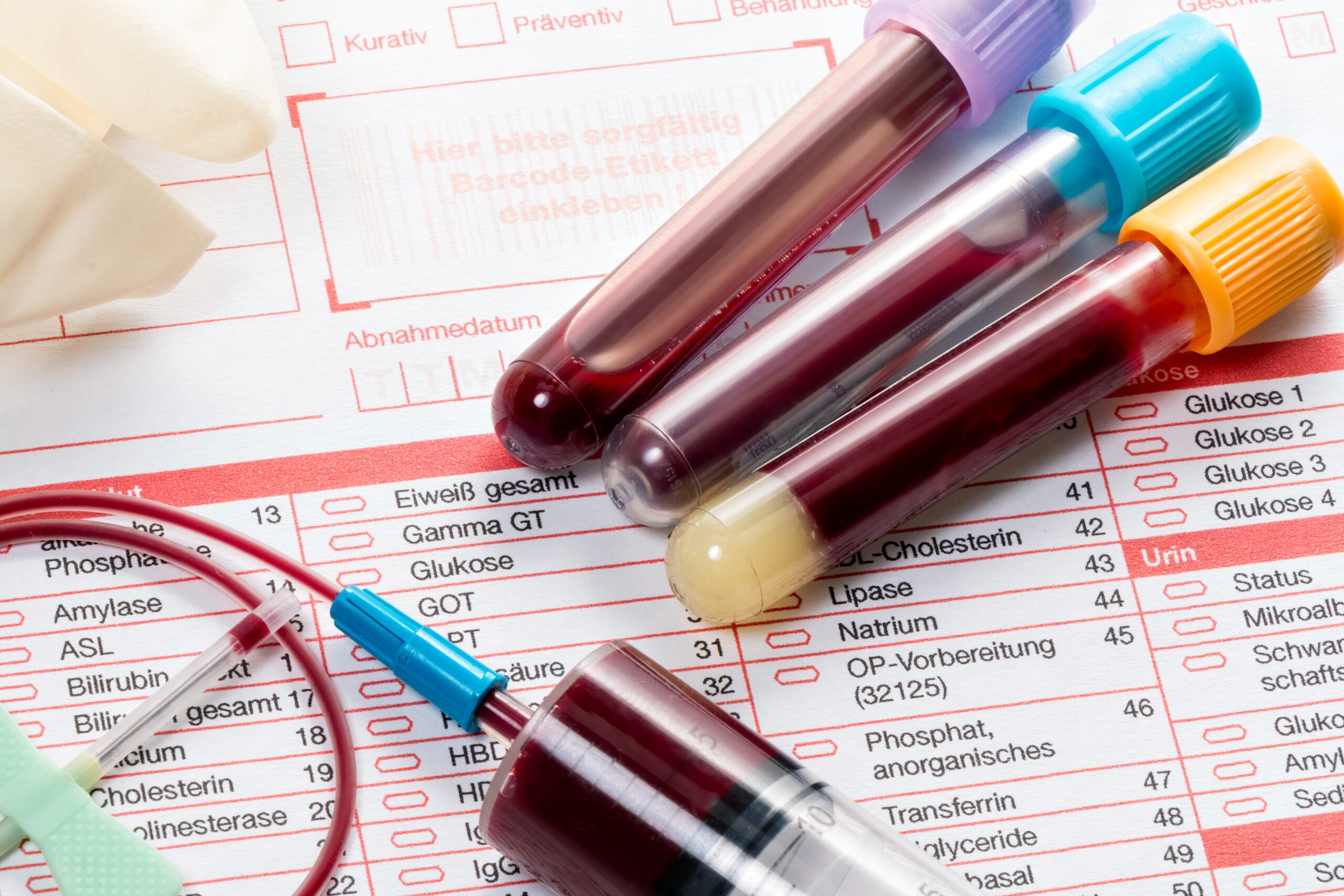 Зачем нужно сдавать анализ крови на СРБ?