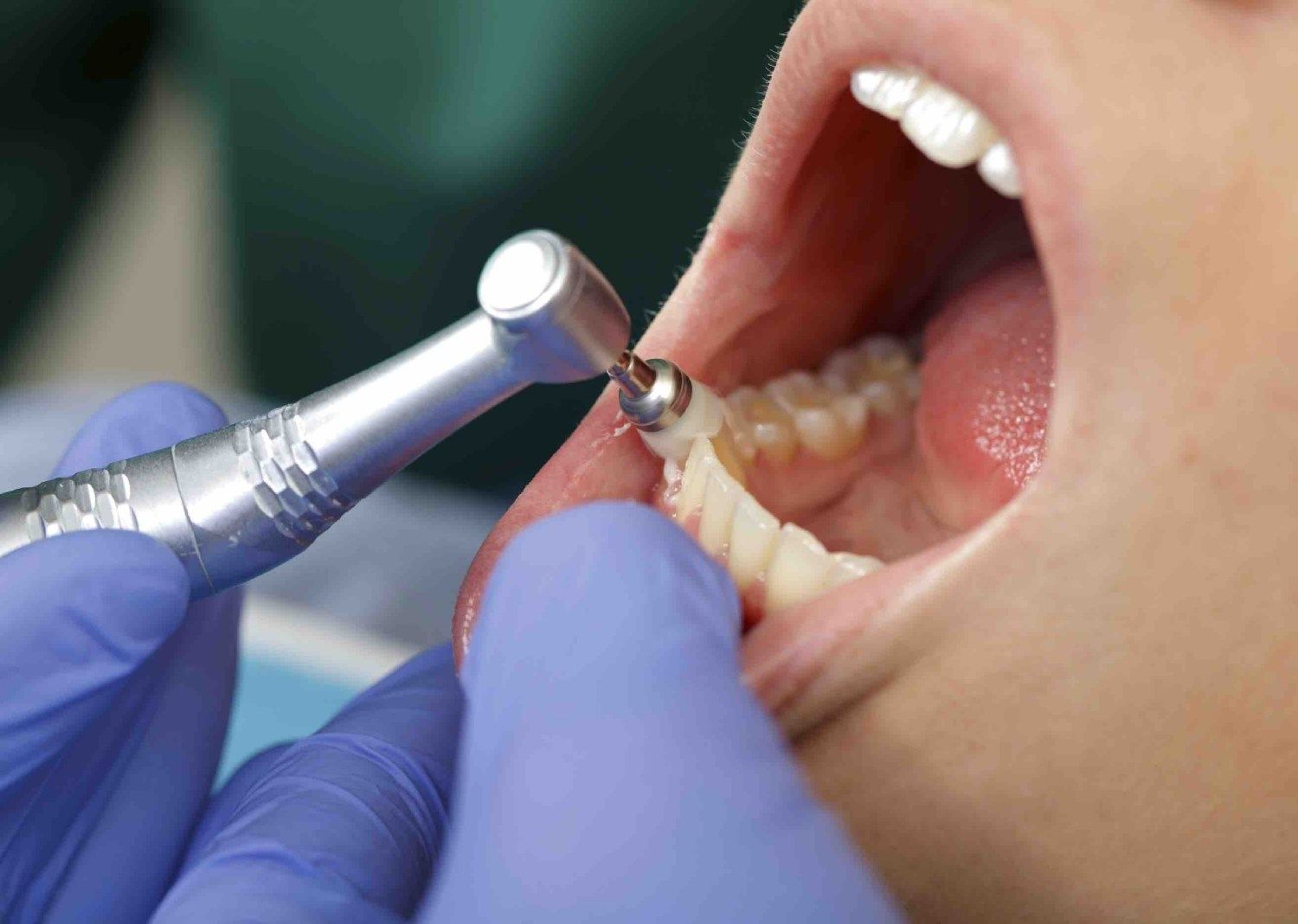 Как лечат запущенные зубы?