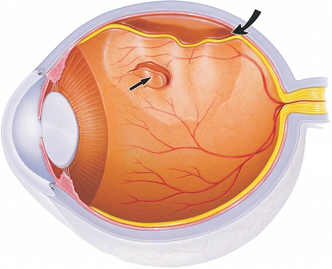 Как лечат отслойку сетчатки глаза?