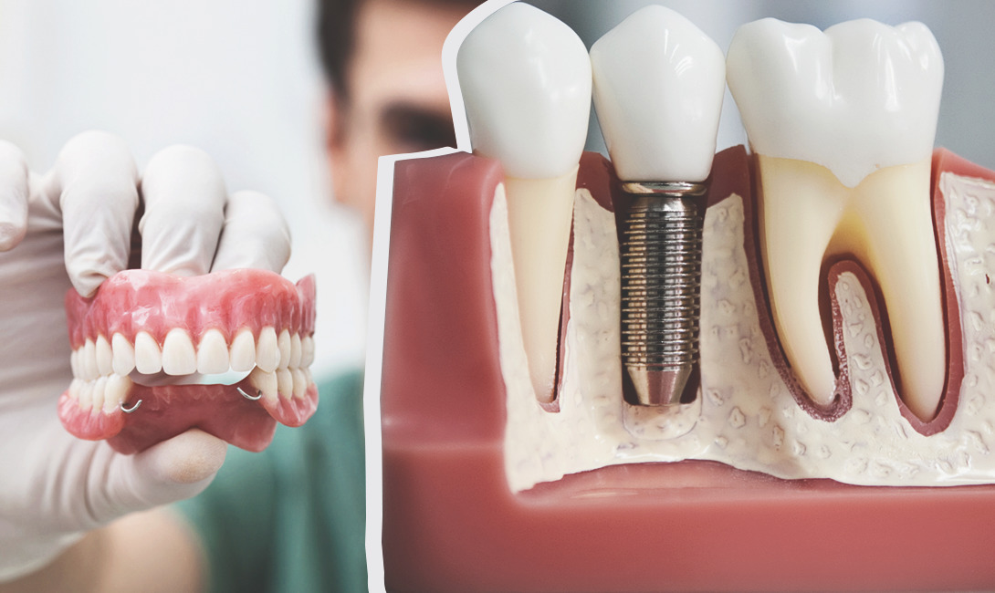 Что входит в стоимость протезирования зубов?
