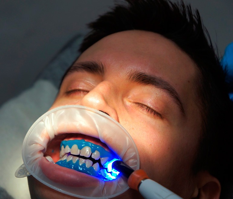 Как проходит процедура отбеливания зубов?