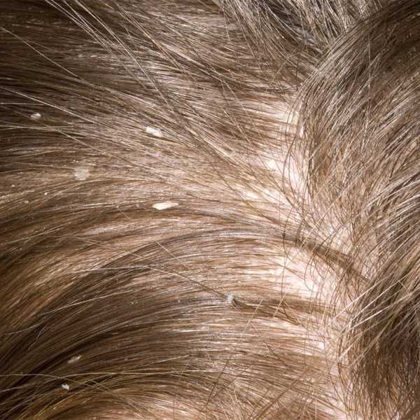 Лечение волос: облысение, перхоть, себорея