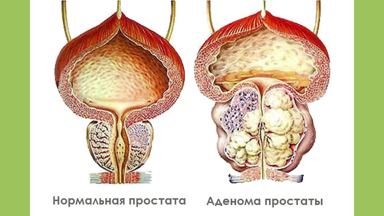 Простатит дгпж. Доброкачественная гиперплазия предстательной железы (ДГПЖ). Аденома; везикулит; простатит. Аденома предстательной железы симптомы.