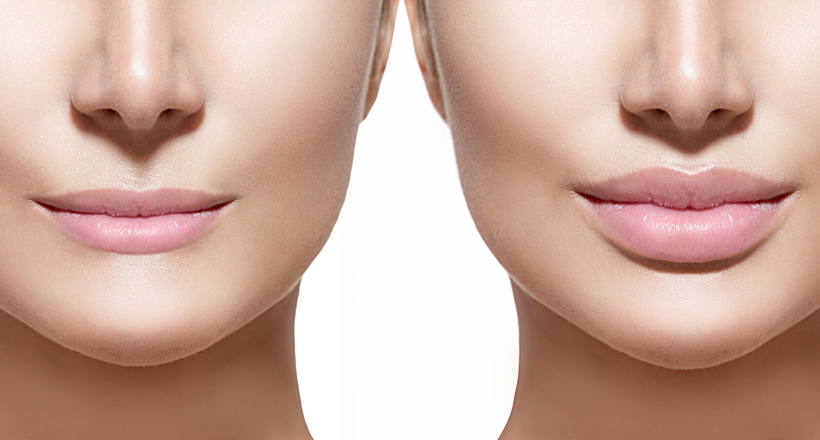 Контурная пластика губ: создаем идеальную форму и объем