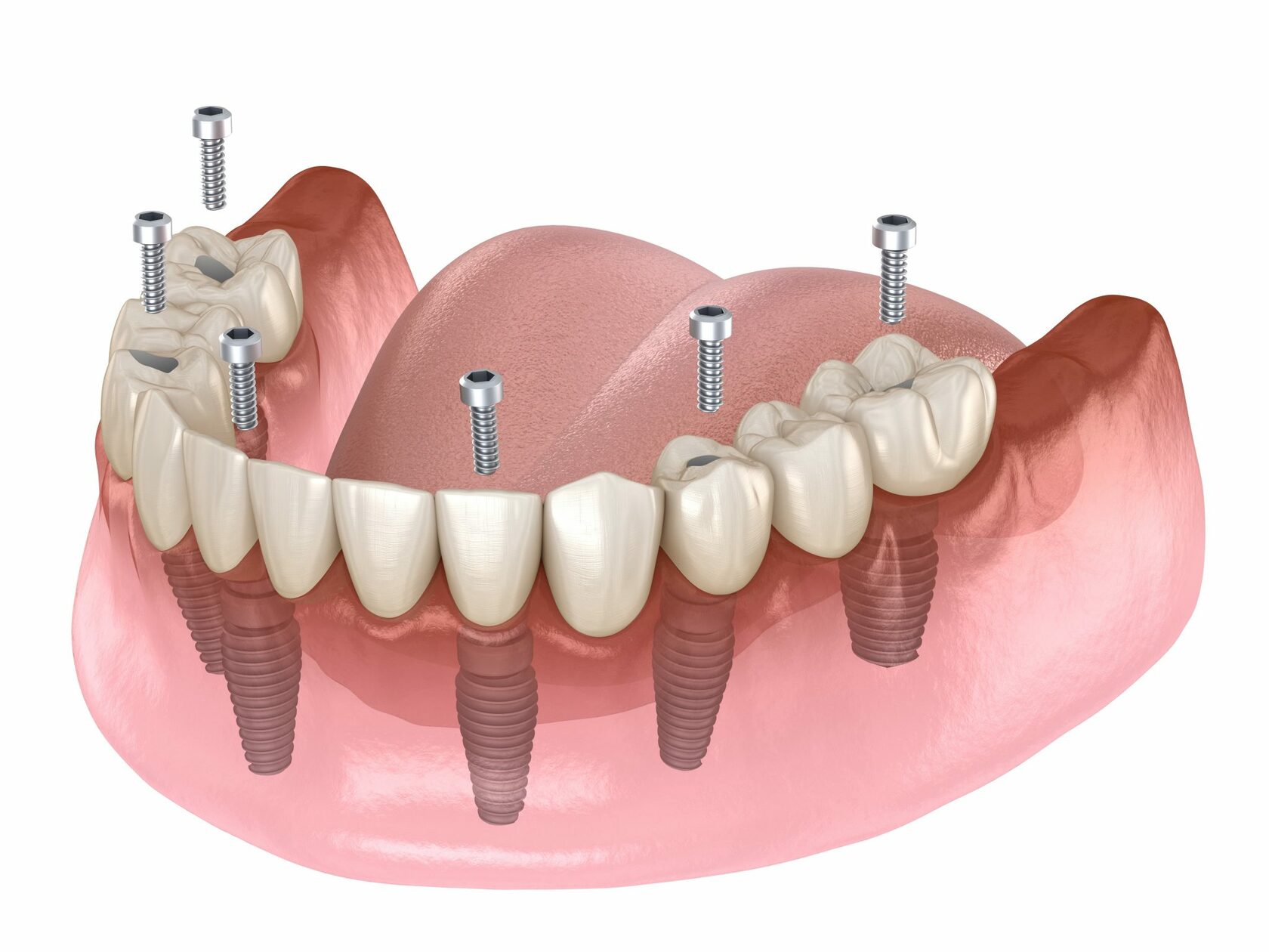 Протезирование зубов на имплантах: возвращение уверенности в себе и эстетического совершенства